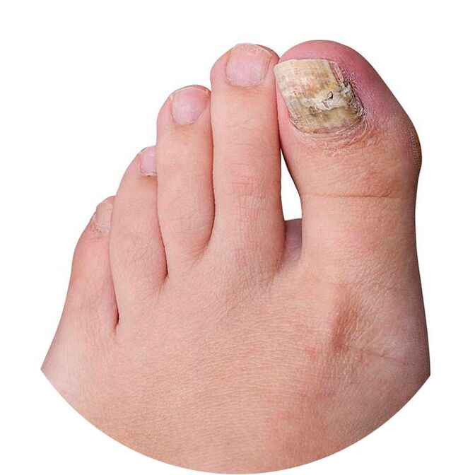 Crema Exodermin para la infección por hongos en los dedos de los pies.