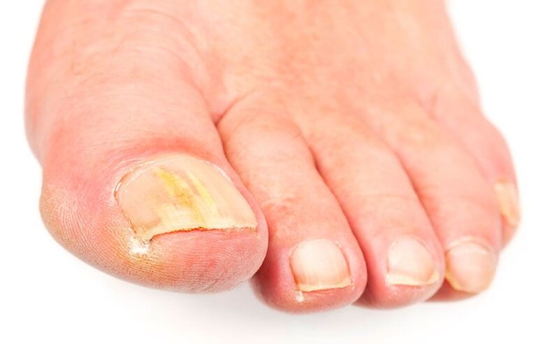 Las causas del hongo