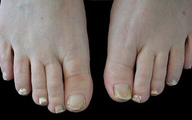 Cómo deshacerse del hongo en sus dedos