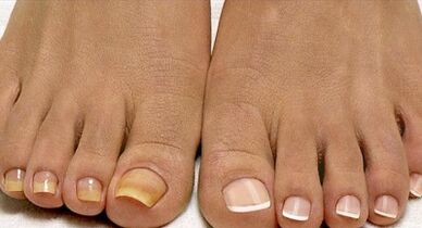 Métodos de tratamiento de hongos de flota