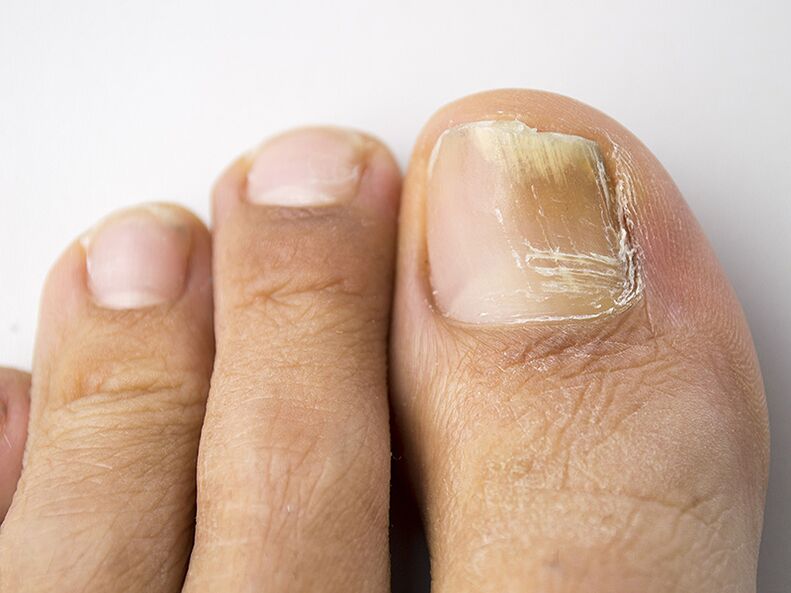 La etapa inicial del hongo