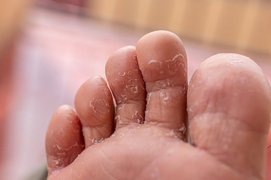 hongos entre los dedos de los pies