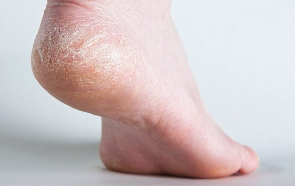 Hongos en la piel de los pies.